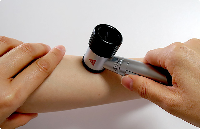 皮膚腫瘍について